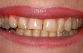 Veneers_AB